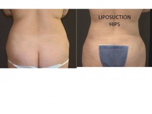 liposuction-2-300x225