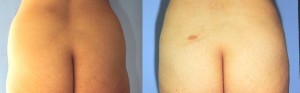 liposuction-7-300x225
