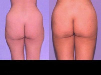 liposuction-8-300x225