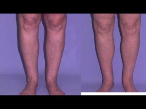 liposuction-9-300x225