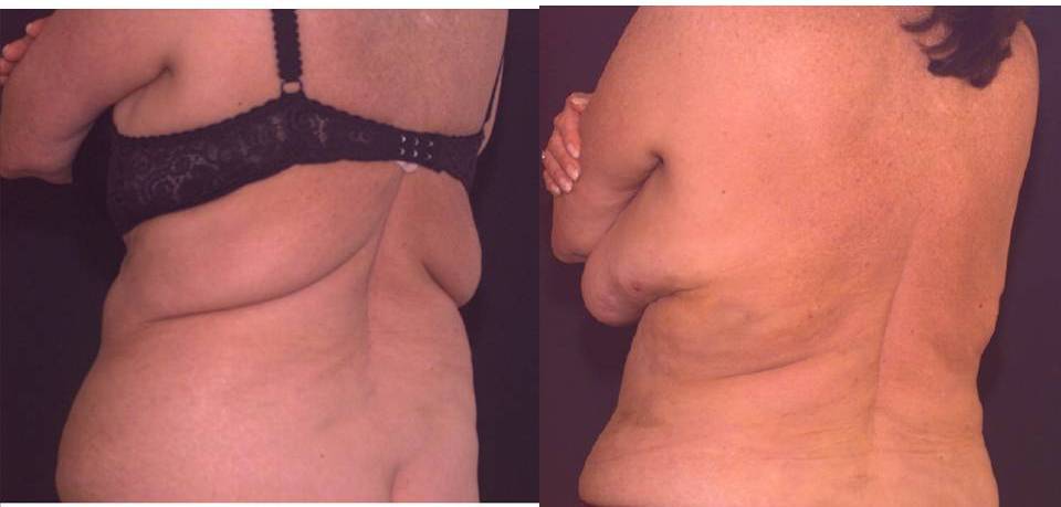Bra Rolls Fat Removal Surgery - Gainesville Liposuction Specialist