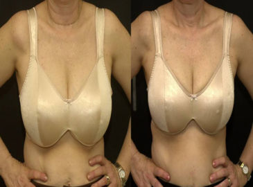 BreastReduction3
