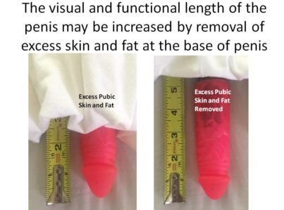 The visual and functional length of the penis