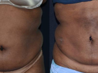 Before and After Abdominal Liposuction